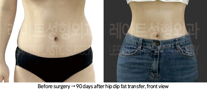 abdominal_liposuction_02_17_240819