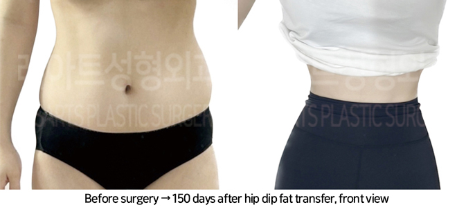 abdominal_liposuction_02_18_240819