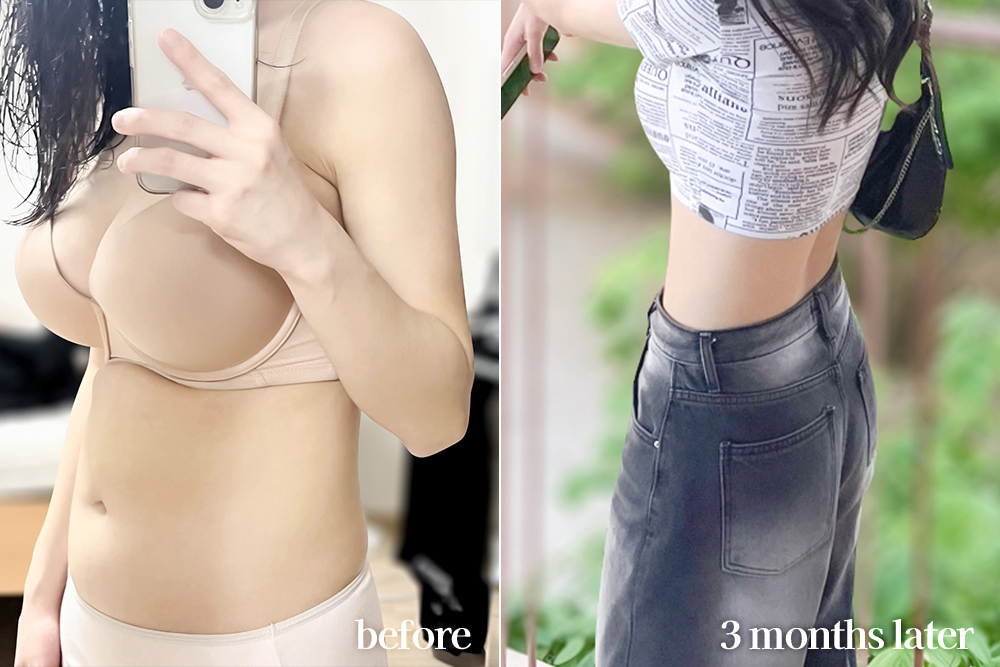 AbdominalLiposuction-review