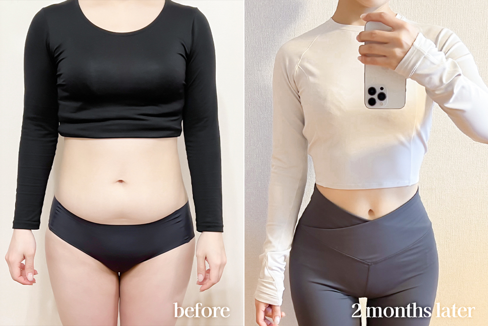 AbdominalLiposuction-review