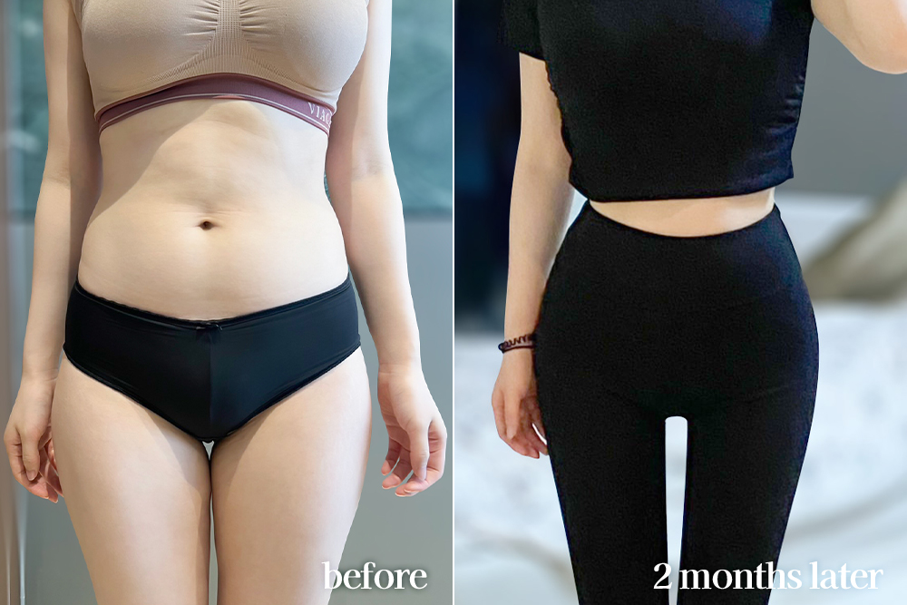 AbdominalLiposuction-review