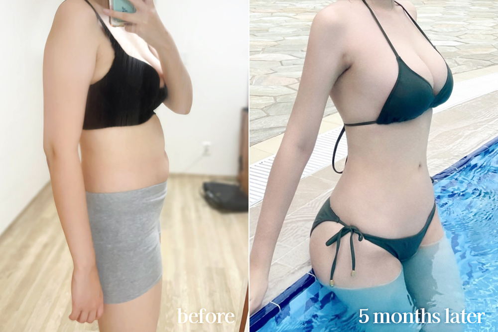 AbdominalLiposuction-review
