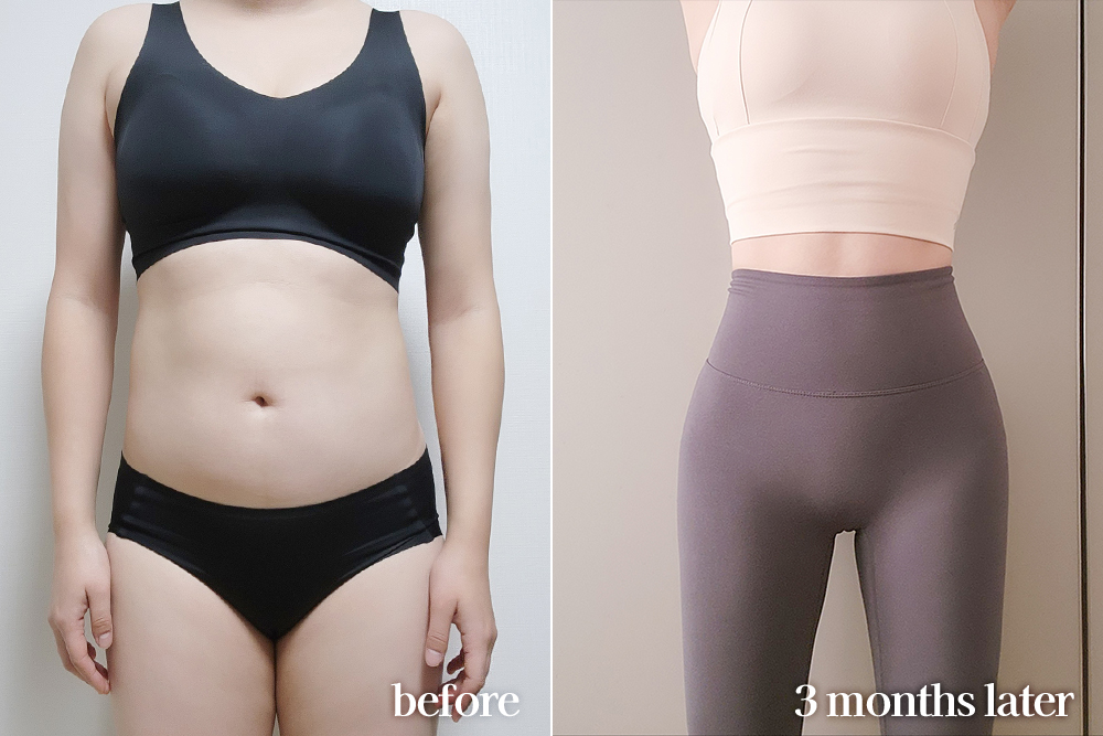 AbdominalLiposuction-review