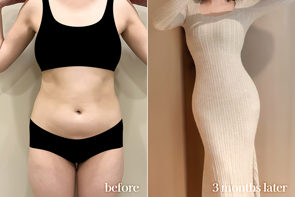 AbdominalLiposuction-review