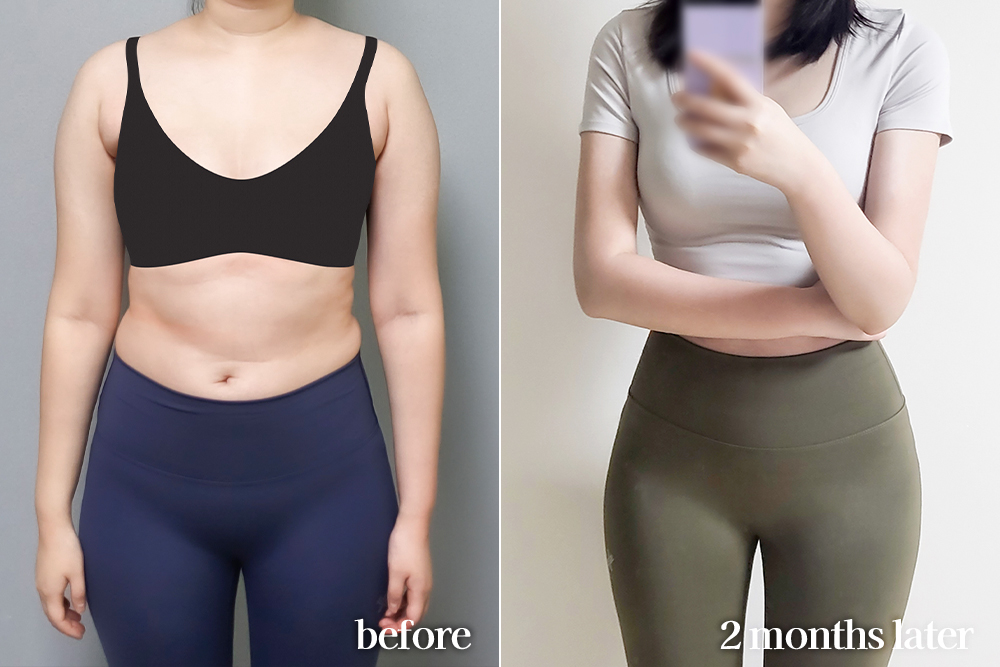 AbdominalLiposuction-review