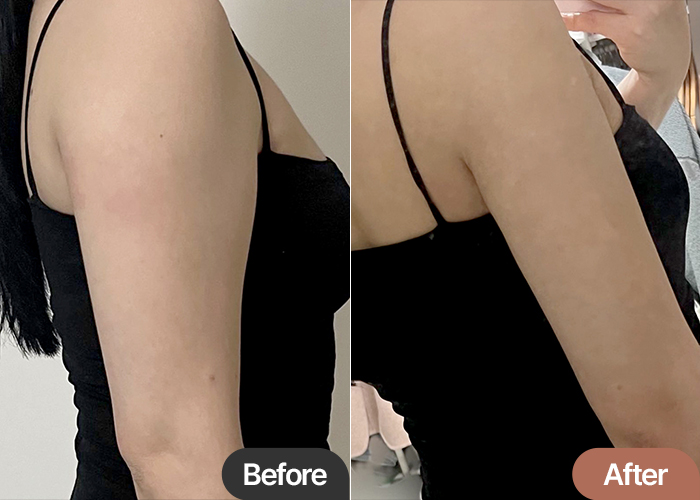 arm-liposuction-thumbnail-Bellamu