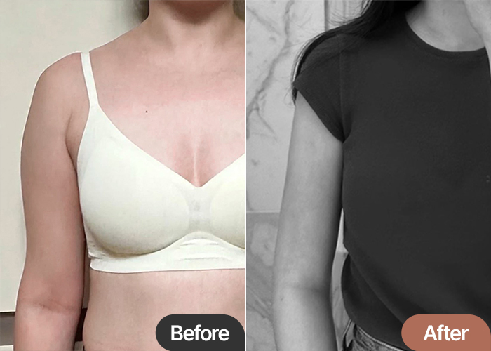 Before and after arm liposuction of Cheer_y in Korea—obvious volume reduction and improved silhouette.