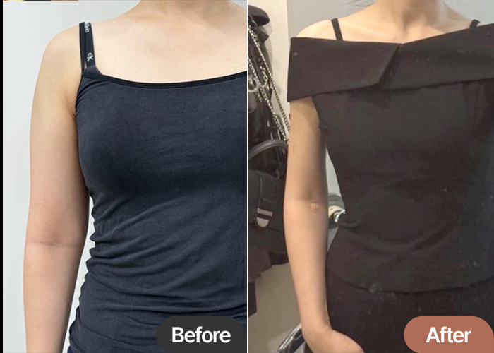 Side-by-side comparison of Daldalijoa’s arm liposuction result at Lesarts in Seoul, before and after surgery.