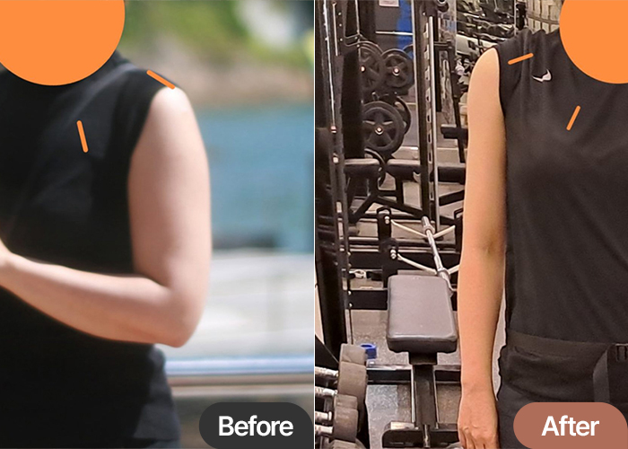 Before and after arm liposuction of Freekong in Korea—clear tapering and improved definition in upper arms.