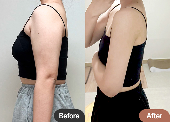 Before and after arm liposuction of Gangidongi in Korea—clear difference in volume, shoulder contour, and arm tone.