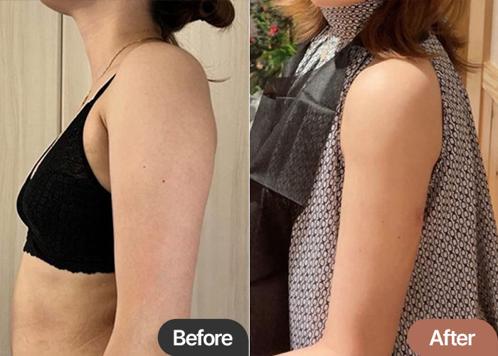 arm-liposuction-thumbnail-Hichama