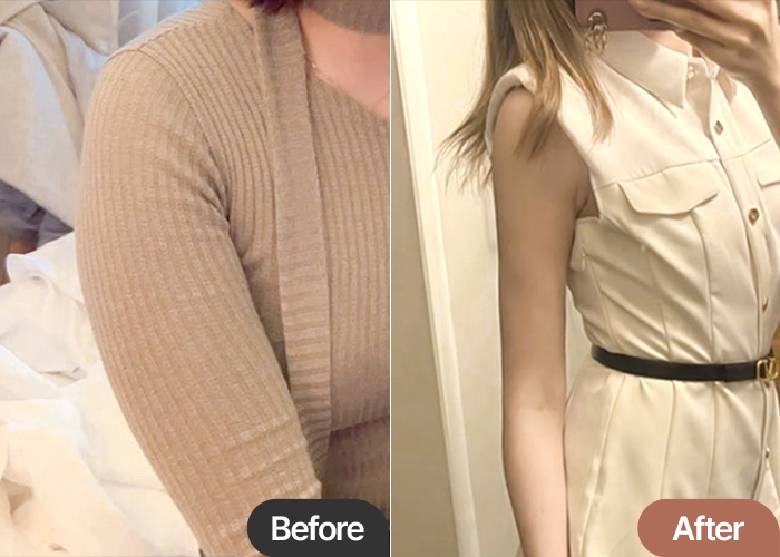Side-by-side comparison of Hiiiiiichama’s arms before and after arm liposuction in Korea, showing a dramatic reduction in size and smoother contour.
