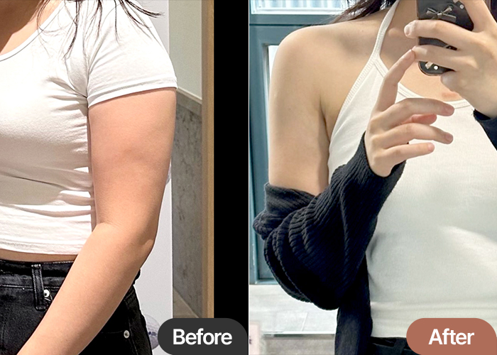 Side-by-side comparison of Izziring’s arm and thigh liposuction before and after surgery at Lesarts in Seoul.