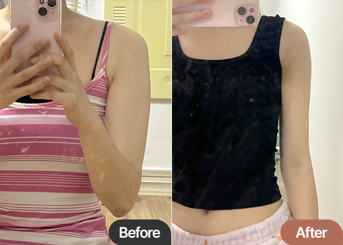 Before and after arm liposuction of Jeoyoi in Korea—noticeable change in upper arm thickness and definition.