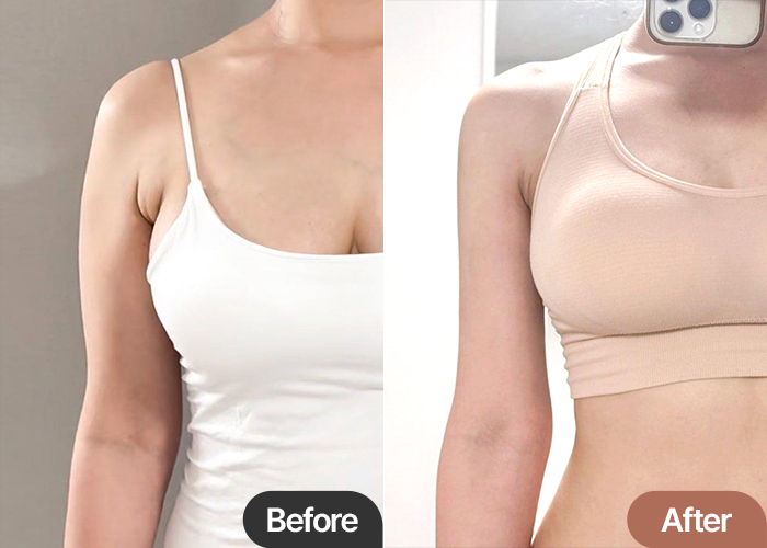 Before and after arm liposuction and accessory breast removal of Jorollo in Korea—significant upper body reshaping.