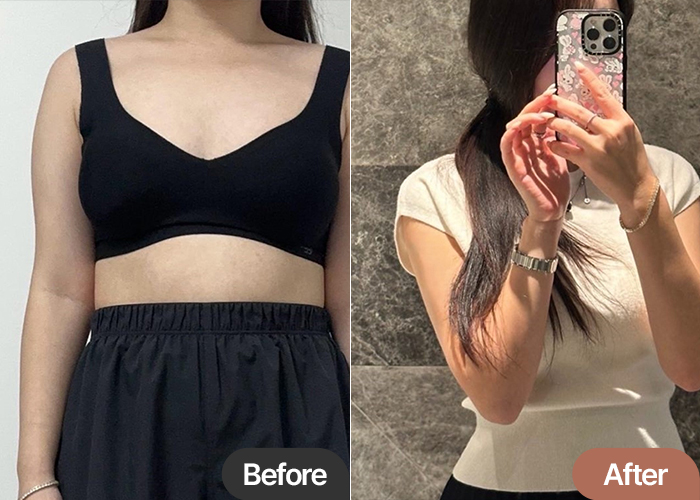 arm-liposuction-thumbnail-KimJichu