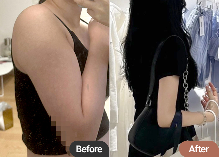 Before and after comparison of Lucia00’s arm liposuction at Lesarts in Korea, showing dramatic contour change.