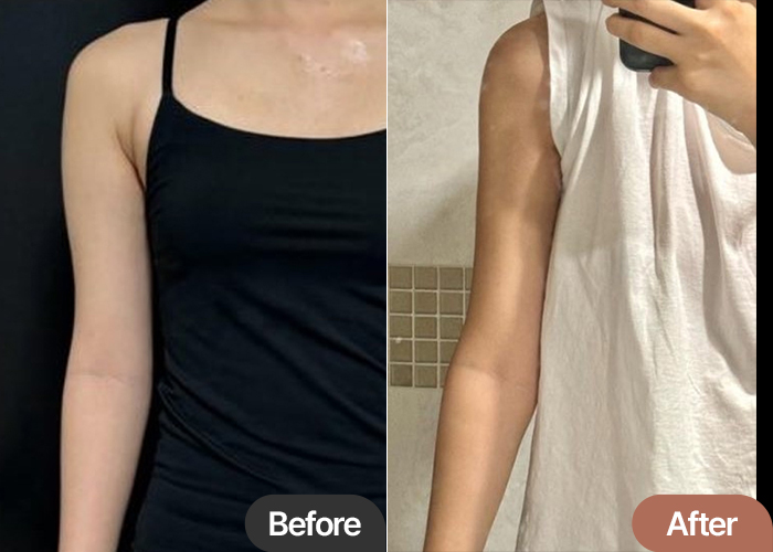 arm-liposuction-thumbnail-Mulgoyangi