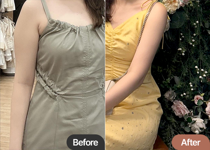 Side-by-side arm liposuction comparison of Nadouippeojillae2, before and after surgery at Lesarts Plastic Surgery Korea.