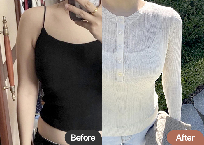 arm-liposuction-thumbnail-Nyangi-after