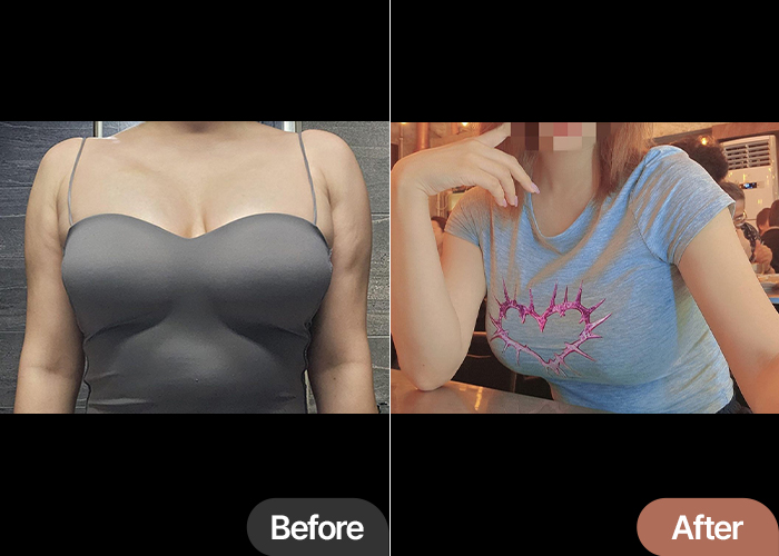 Side-by-side comparison of NyangiHNPq9’s arm liposuction before and after at Lesarts, showing reduced bulk and improved contour.