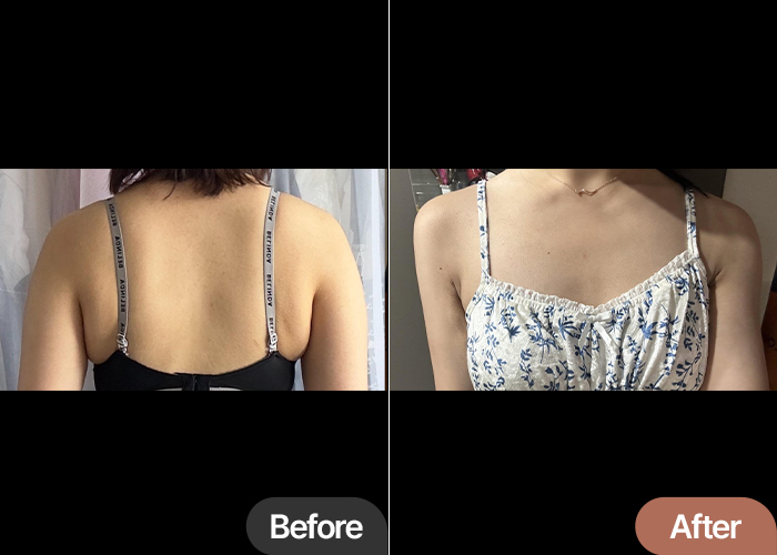 Before and after arm liposuction of Nyangiq4BuF in Korea—upper arms look visibly slimmer and more balanced.