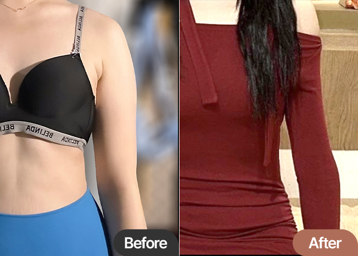 Before and after comparison of Nyangiq4BuF’s arm liposuction in Korea—clear reduction in volume and improved silhouette.