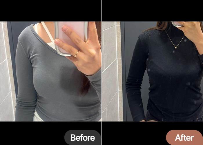 Before and after arm liposuction of Ppyoboking in Korea—dramatic reduction in upper arm size and improved clothing fit.