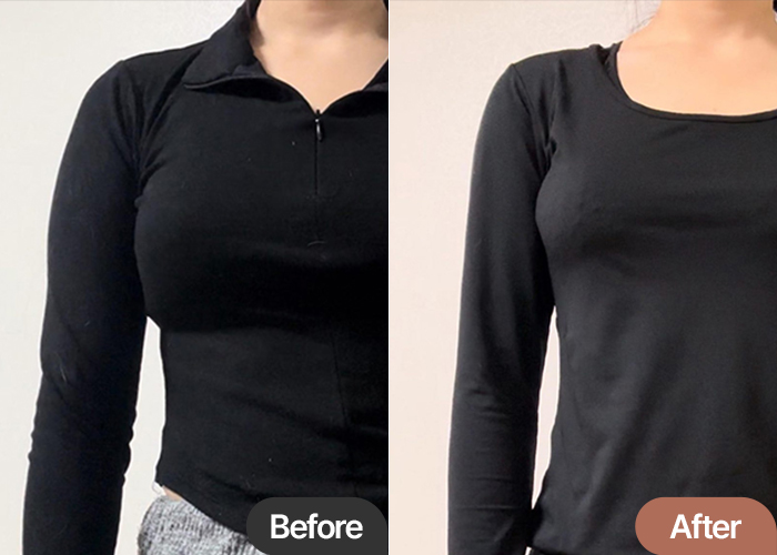 Before and after arm liposuction of Roroppungppangyi in Korea—clear difference in tightness and silhouette.