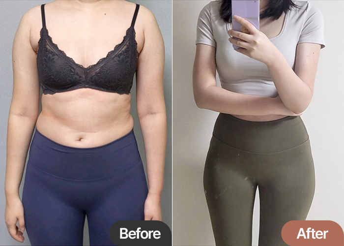 arm-liposuction-thumbnail-Rree2