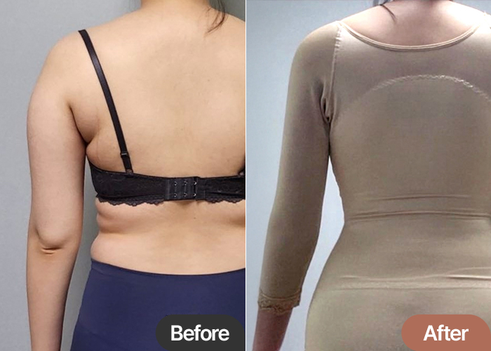 arm-liposuction-thumbnail-Rree2