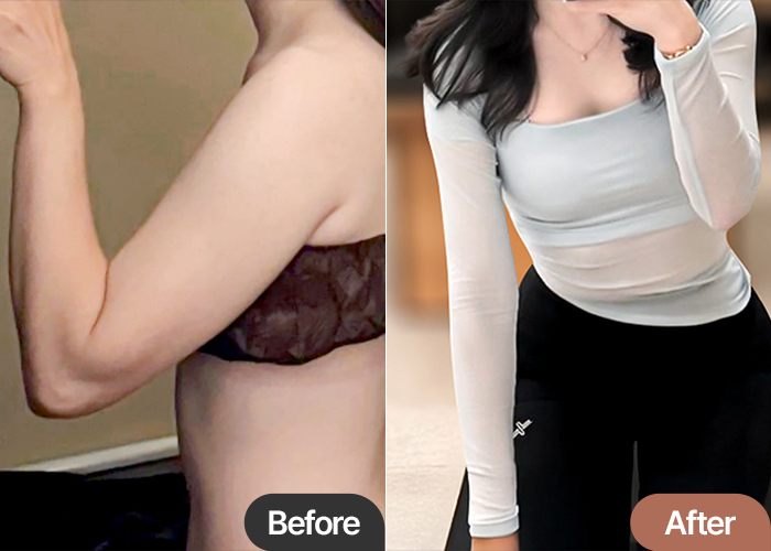 Before and after arm liposuction of Santamarianobellam in Korea—dramatic reduction in arm volume and sculpted contour.