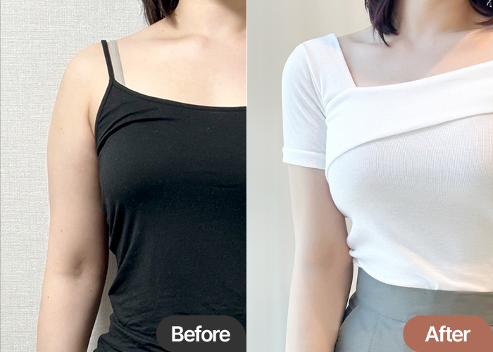 Arm Liposuction 2-Month | My satisfaction is really high!so good!