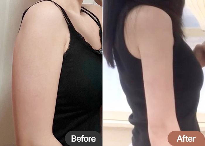 arm-liposuction-thumbnail-Ssovv