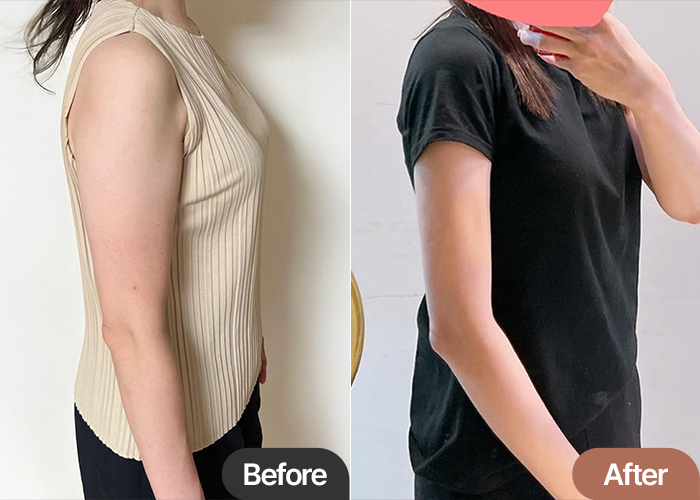 Before and after arm & upper body liposuction of UnniVLeS5o in Korea—clear reduction in upper arm and armpit volume.