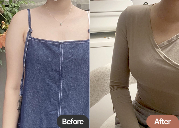 Comparison of bbella2's arm liposuction in Korea (Apgujeong)—bulky upper arms visibly slimmed post-surgery.
