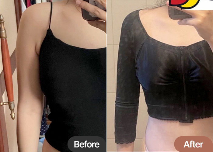 arm-liposuction-thumbnail-nyangicHYH6