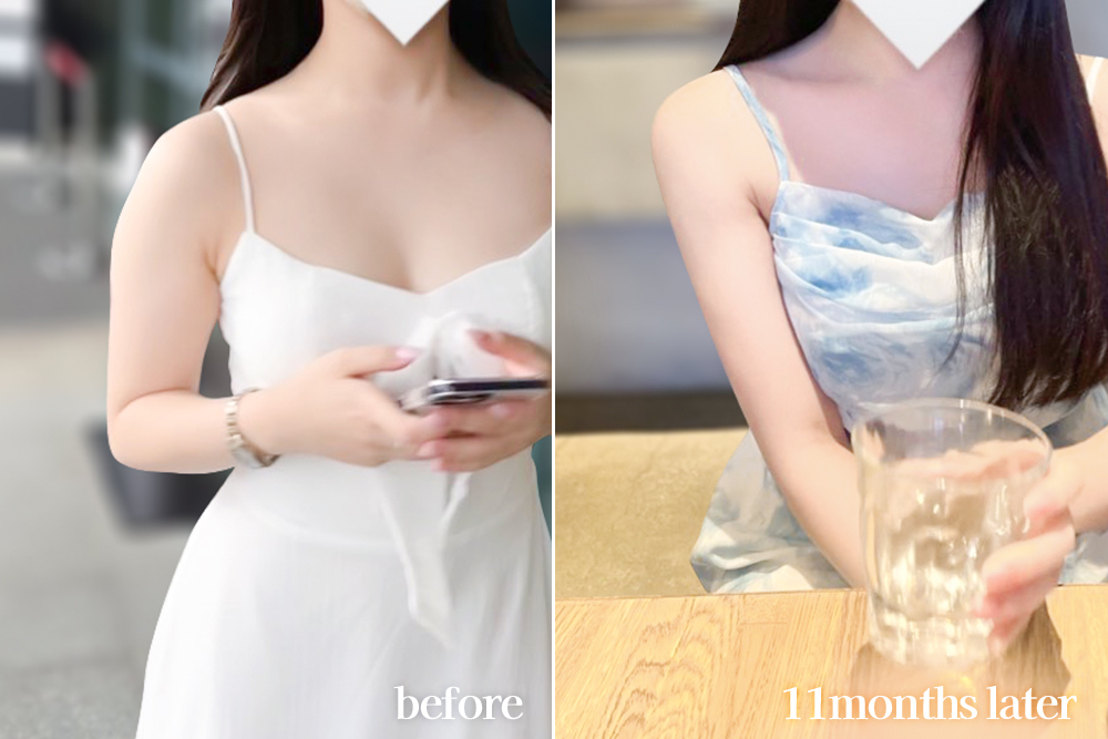 armLiposuction-review