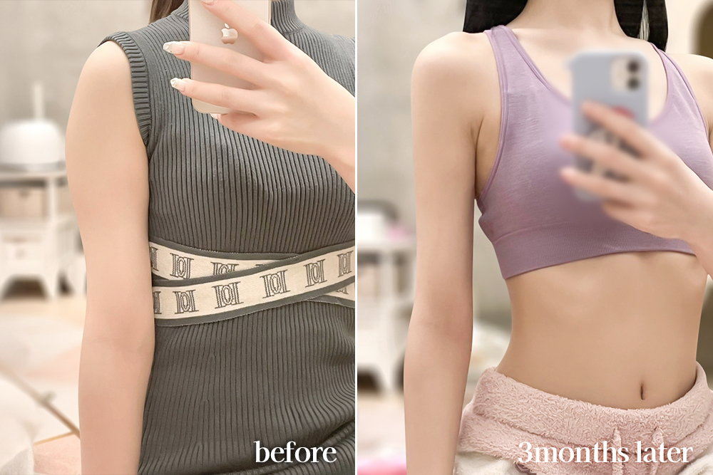 armLiposuction-review