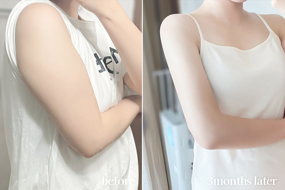armLiposuction-review