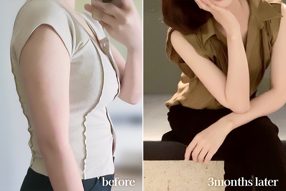 armLiposuction-review