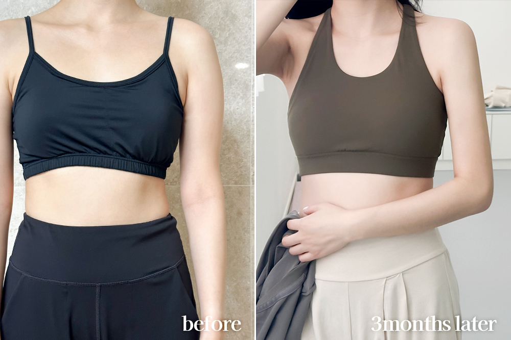 armLiposuction-review
