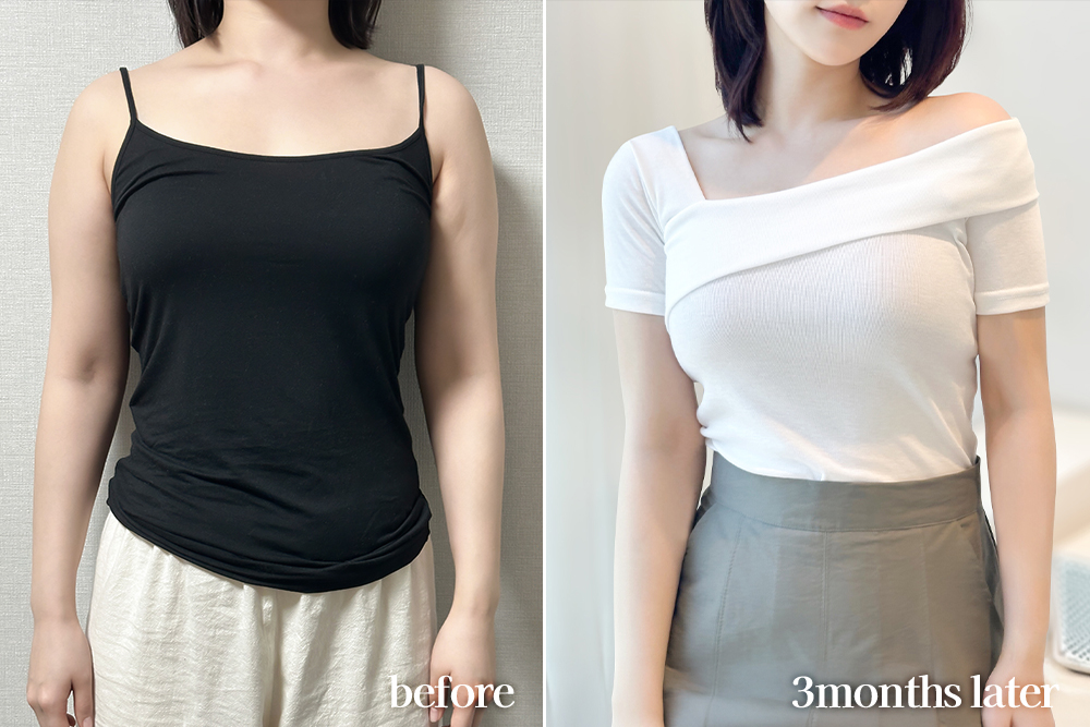 armLiposuction-review