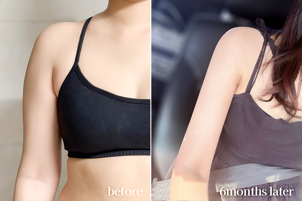 armLiposuction-review