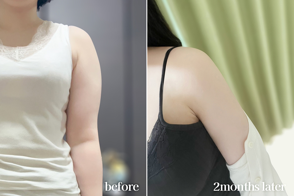 armLiposuction-review