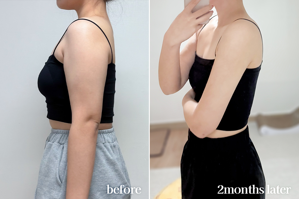 armLiposuction-review