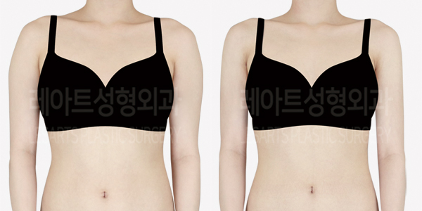arm_liposuction_01_thumbnail_240826