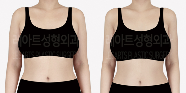 arm_liposuction_01_thumbnail_240911