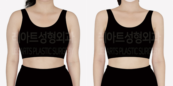 arm_liposuction_01_thumbnail_240913