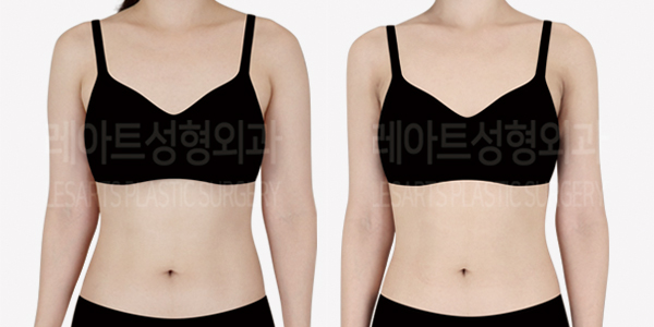 arm_liposuction_01_thumbnail_240920